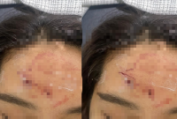 Korban penganiayaan saat menunjukkan luka yang dialaminya.