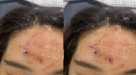 Korban penganiayaan saat menunjukkan luka yang dialaminya.